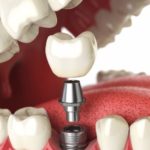 Имплантация зубов. Что нужно знать и куда обратиться.