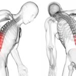 Протрузия межпозвоночного диска